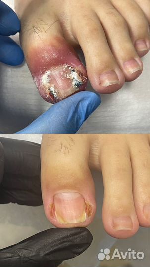 Подолог. Вросший ноготь. Титановая нить