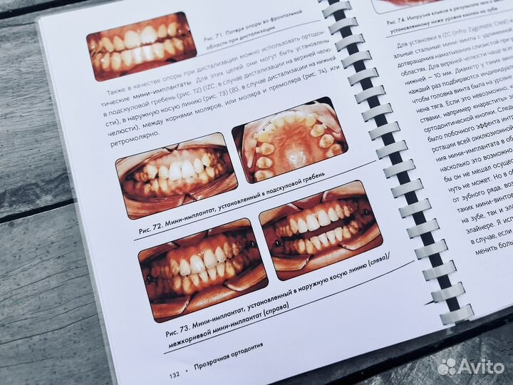 Прозрачная ортодонтия
