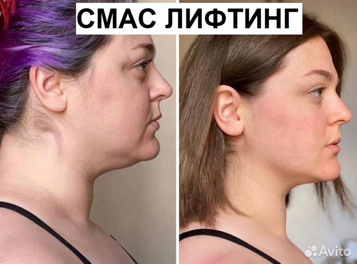 Лифтинг эффект