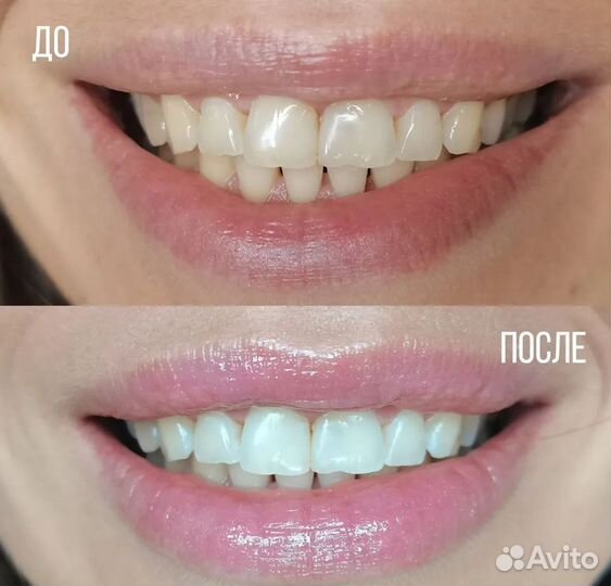 Подарочные сертификаты на отбеливания зубов