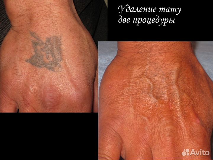 Лазерное удаление татуажа, тату