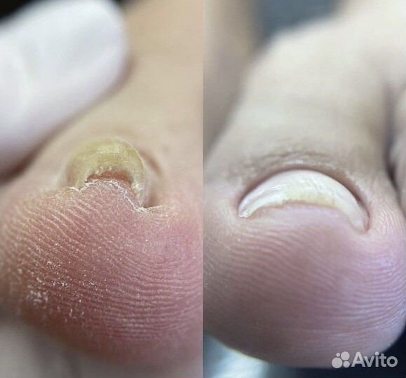 Педикюр, подолог