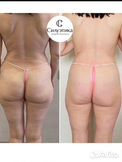 Антицеллюлитный, лимфодренажный массаж