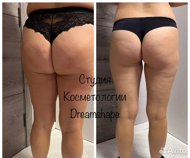 Аппаратный,вибрационно-роликовый массаж,кавитация