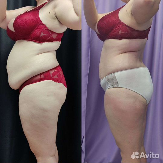 Вакуумный массаж, РФ- лифтинг, кавитация