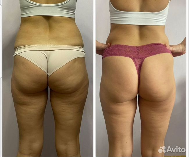 Вакуумный массаж для похудения