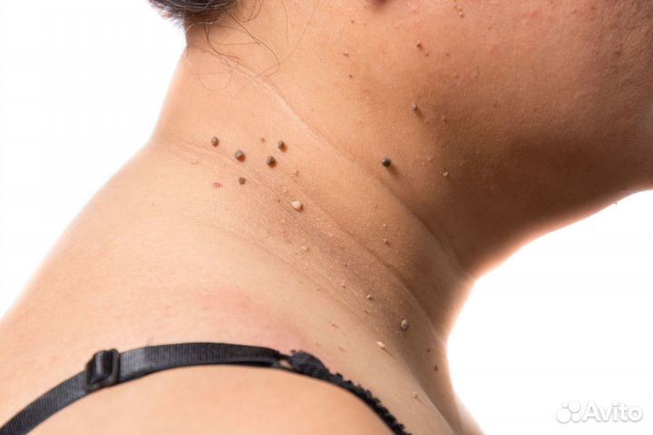 Удаление папиллом, шипиц, кератом, жировиков