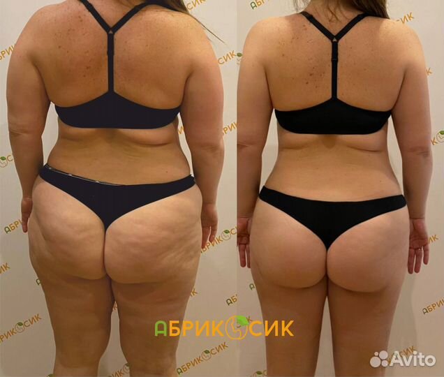 LPG массаж для похудения