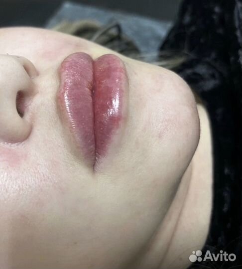 Увеличение губ,ботокс,лифтинг нити