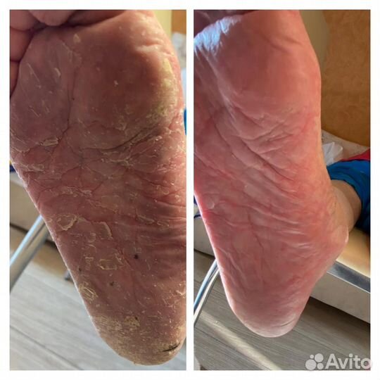 Подолог.Вросший ноготь