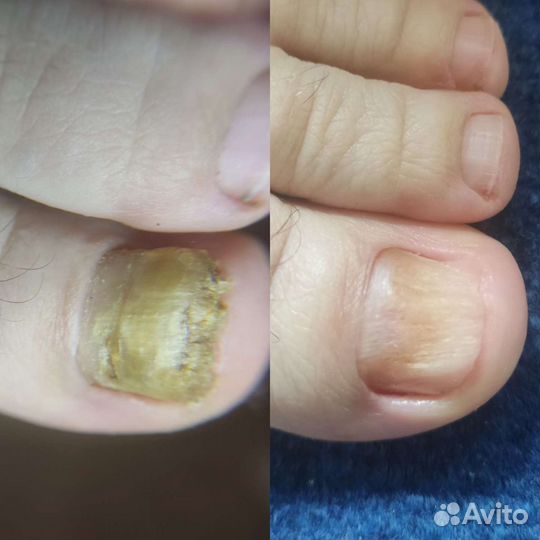 Аппаратный педикюр