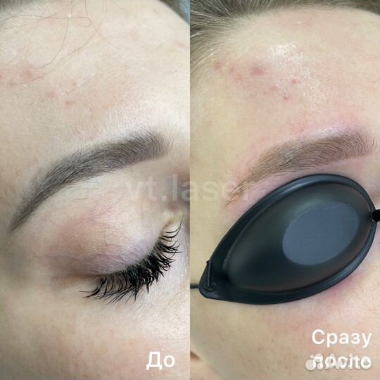 Лазерное удаление тату и татуажа