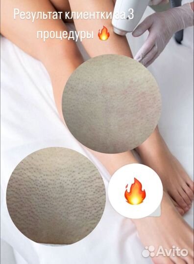 Лазерная эпиляция