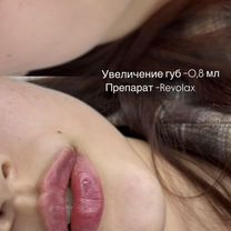 Увеличение губ, Майкоп