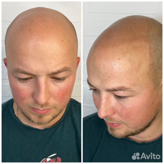 Трихопигментация по методу SMP