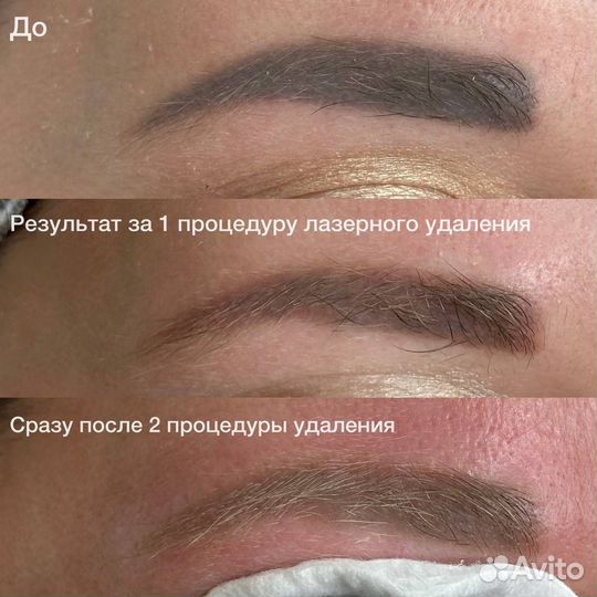 Удаление татуажа бровей, тату