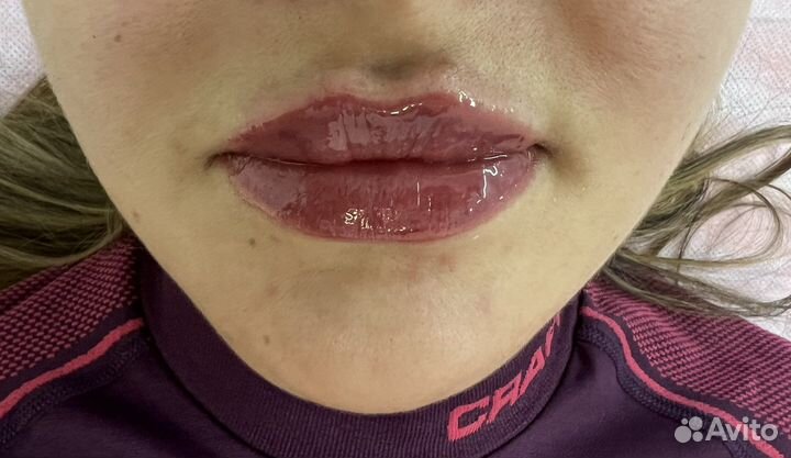 Ультразвуковая чистка лица