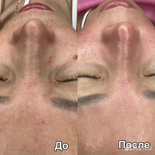 Косметолог/чистка лица/пилинг