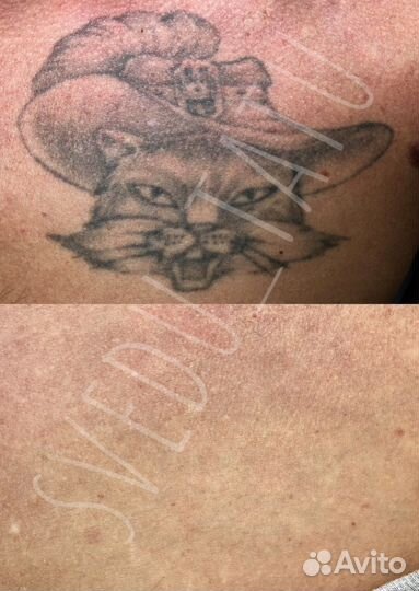 Лазерное удаление татуировок и татуажа Пирсинг