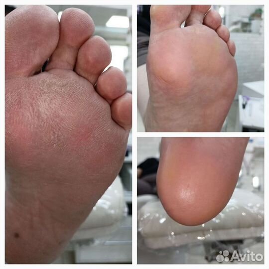 Смарт педикюр