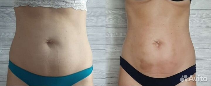 Антицеллюлитный массаж