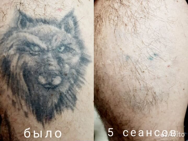 Лазерное удаление тату