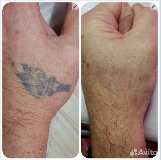 Лазерное удаление татуировок