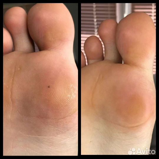 SMART - педикюр