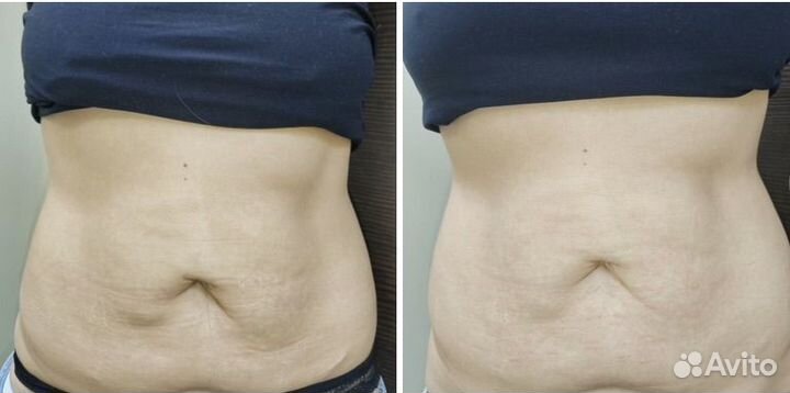 СМАС лифтинг (без боли)