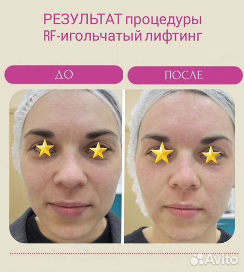 Rf игольчатый аппаратное омоложение в СПБ