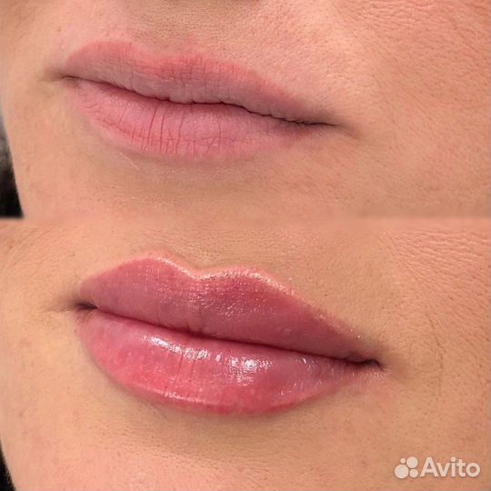 Врач - косметолог, ботокс, коллагенотерапия