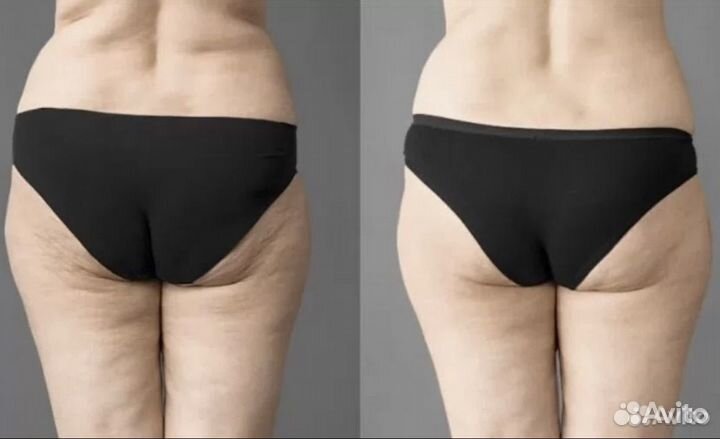 LPG и массаж для похудения специально для тебя