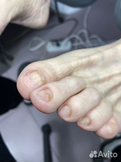 Подолог Елец Медицинский педикюр