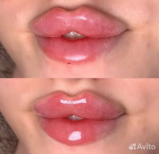 Модель на увеличение губ