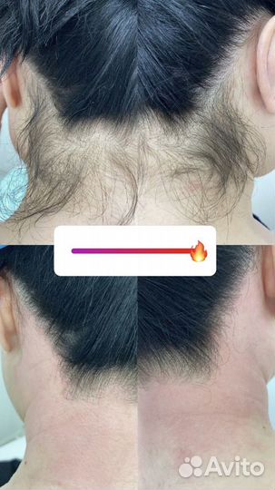 Шугаринг эпиляция