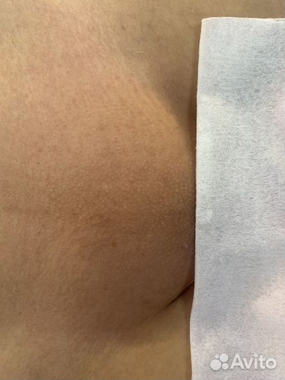 Шугаринг, восковая депиляция, эпиляция