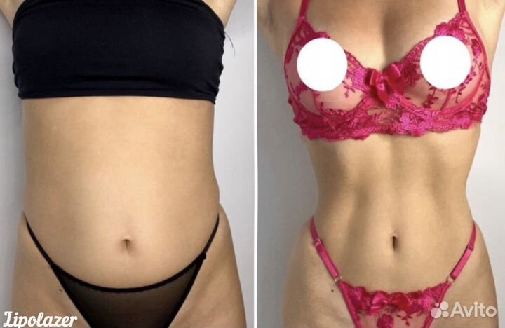Коррекция силуэта/Липолазер