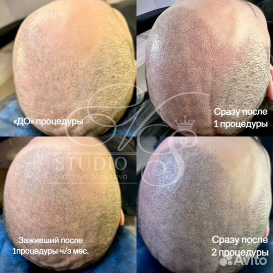 Трихопигментация SMP головы