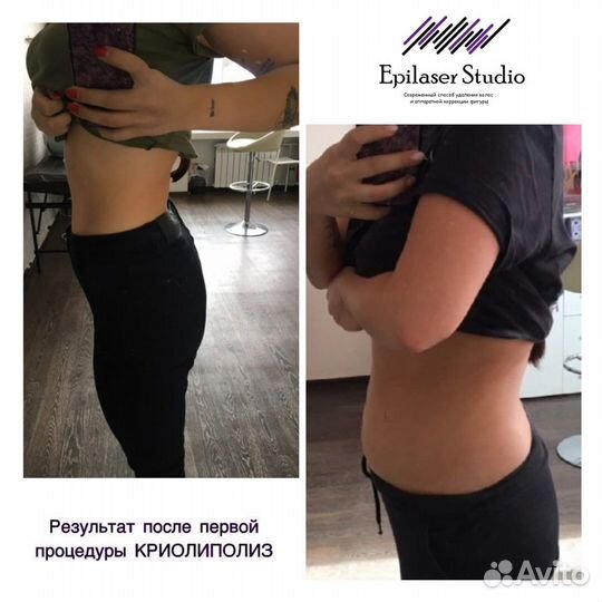 Криолиполиз -минус размер за одну процедуру