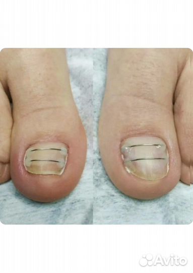 Подологический педикюр