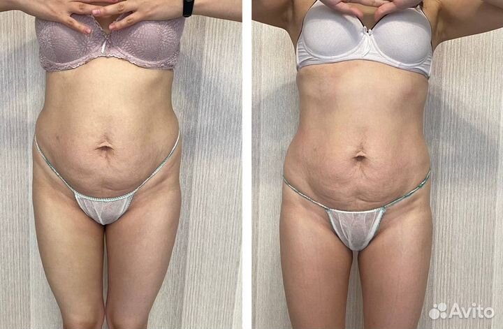 Антицеллюлитный массаж