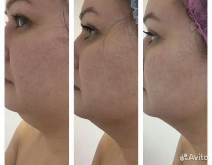 Буккальный массаж