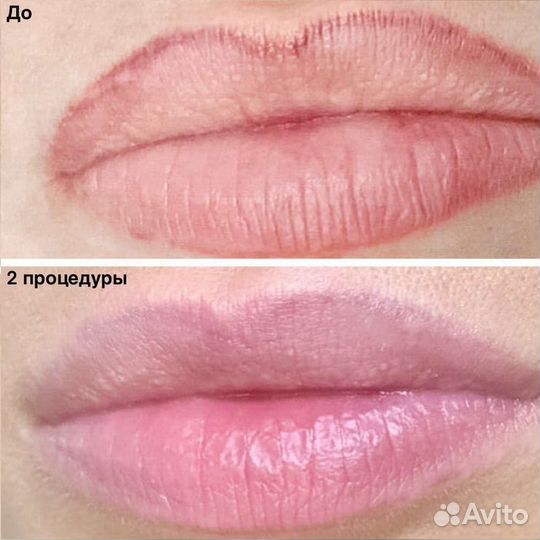 Удаление некачественного татуажа ремувером