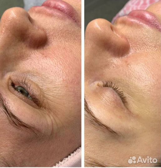 Косметолог, чистка лица, пилинги, хиромассаж