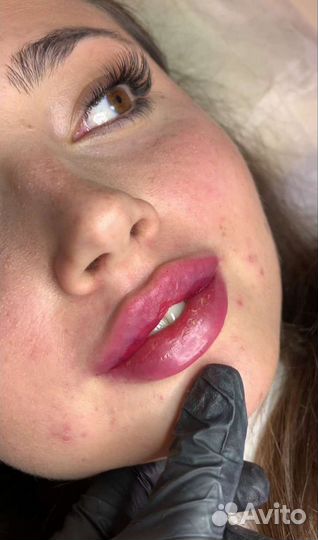 Биоревитализация