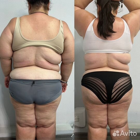 LPG, вакуумный, вибромассаж, антицеллюлитный