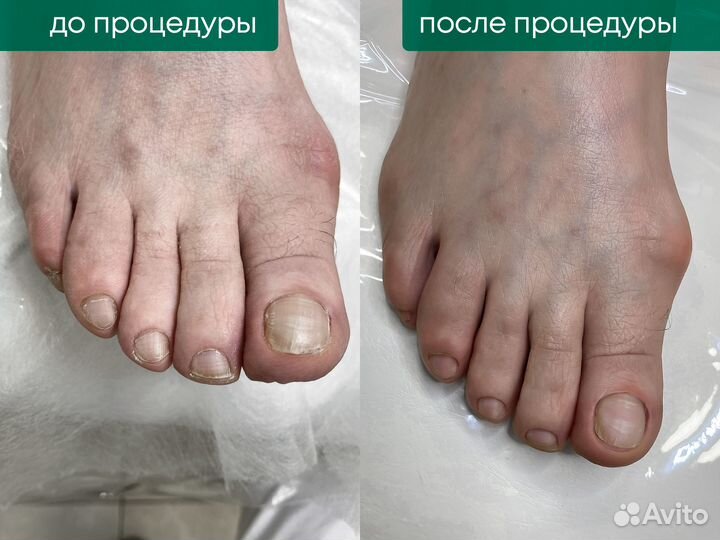 Подолог, лечение грибка, вросшие ногти, мозоли