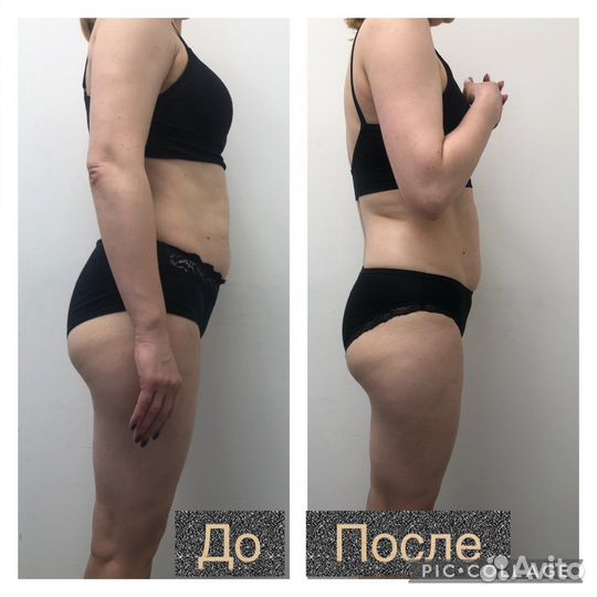 Массаж Антицеллюлитный Похудение Лучше LPG