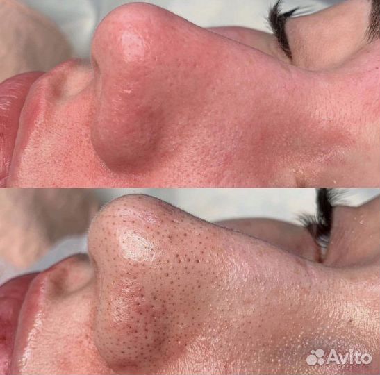 Косметолог чистка лица