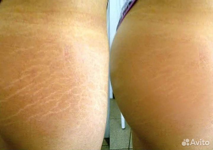 Камуфляж шрамов, ореол. Перекрытие татуажа